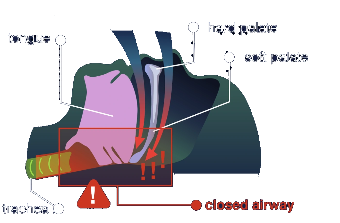 Cross-section of a head with tongue, hard palate, soft palate and trachea labelled. A red box marks where the tongue and soft palate have fallen together and closed the airway, with a warning triangle and the words closed airway.